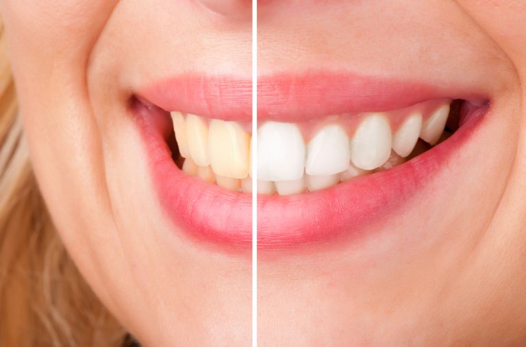 TeethWhitening_slide3-768 https://oshawadentists.ca/wp-content/uploads/2024/10/TeethWhitening_slide3-768.jpg